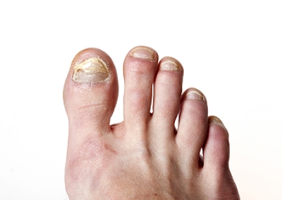 Causes and Relief Options for Toenail Fungus