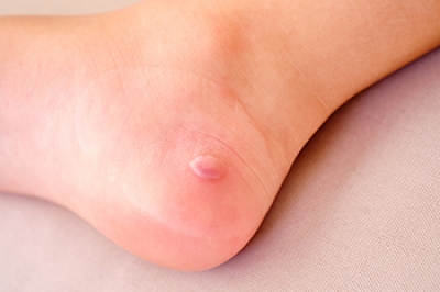 Foot Blisters May Be Linked to Diabetes