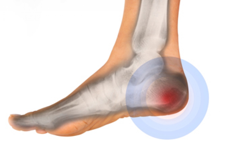 Heel Pain and the Plantar Fasciitis