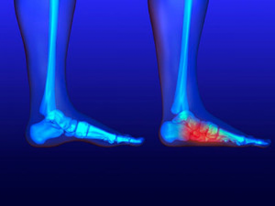 Can Obesity Cause Flat Feet?