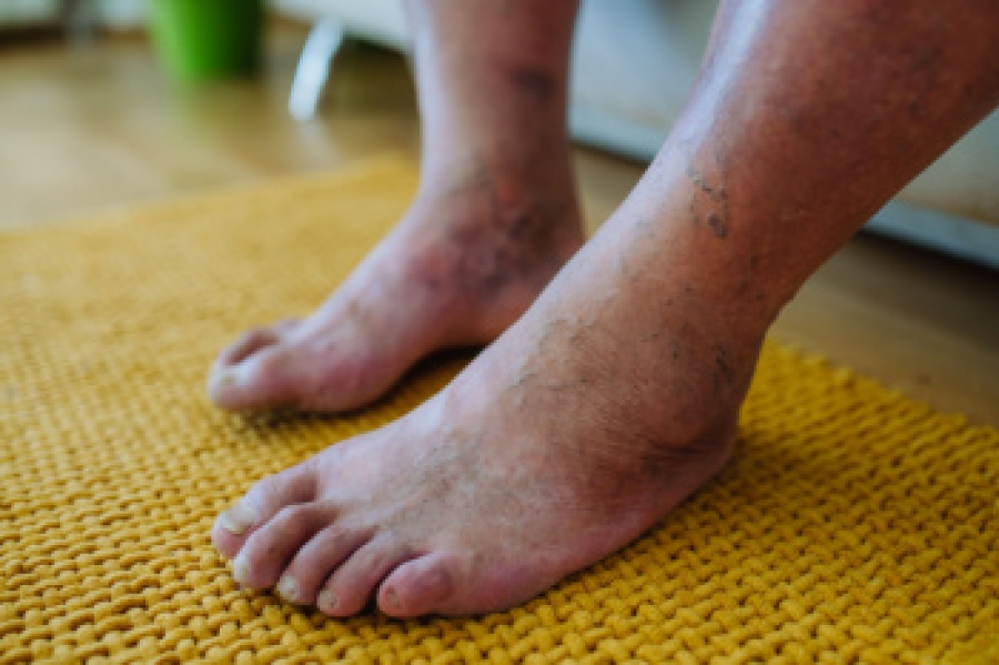 Diabetes-related Foot Problems